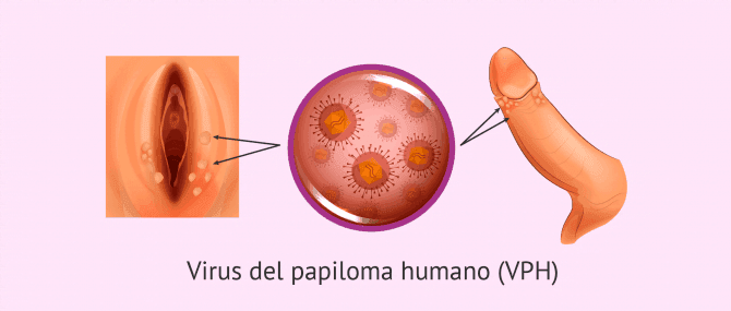 Imagen: Verrugas por el virus del papiloma humano