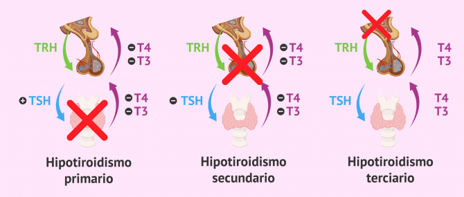 Imagen: Tratamiento con hormonas para el hipotiroidismo