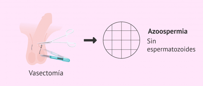 Imagen: vasectomia-azoospermia