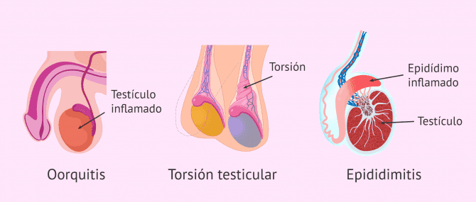 Imagen: Golpe en los testículos y sus consecuencias