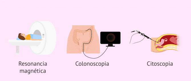 Imagen: Pruebas complementarias para diagnosticar la endometriosis