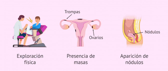 Imagen: ¿Qué puede ser indicativo de la endometriosis?