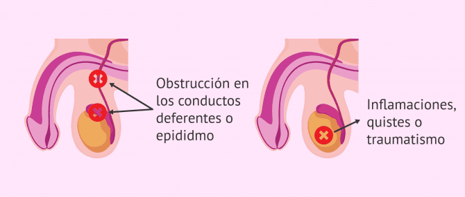 Imagen: Causas de la azoospermia obstructiva