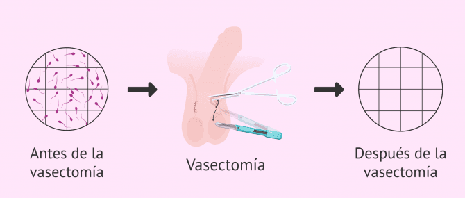 Imagen: Ausencia de espermatozoides después de la vasectomía