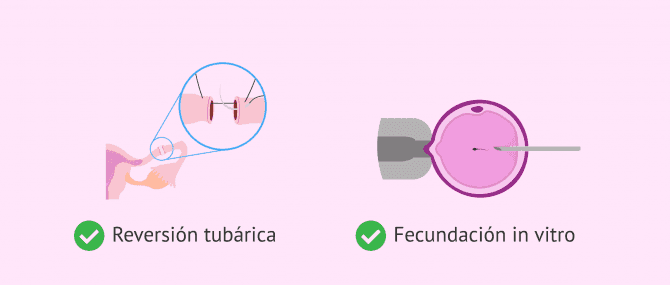 Imagen: Opciones de embarazo tras una ligadura de trompas