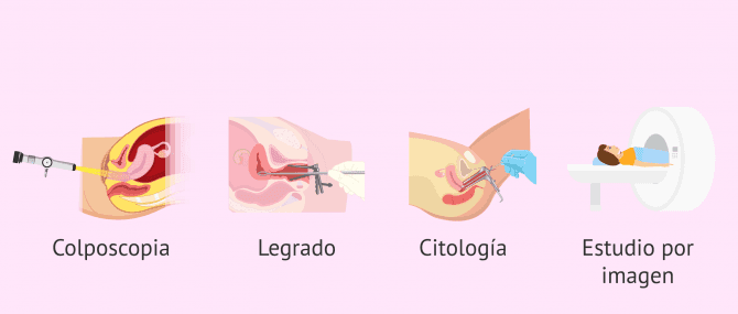 Imagen: Pruebas diagnósticas del cáncer de cuello uterino