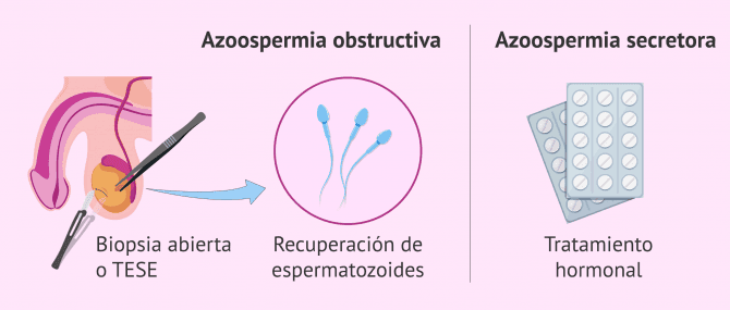 Imagen: Opciones terapéuticas de la azoospermia