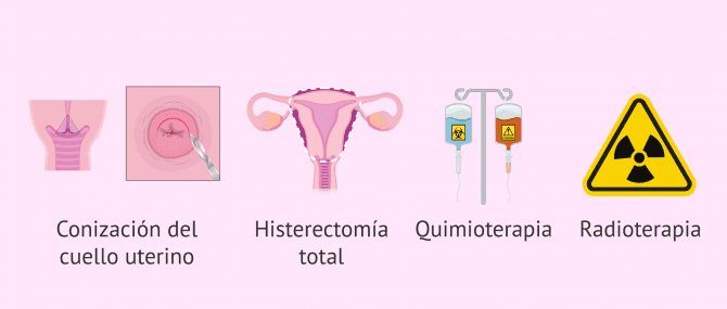 Imagen: Opciones terapéuticas del cáncer de cérvix