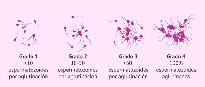 Imagen: Diferentes grados de aglutinación de los espermatozoides