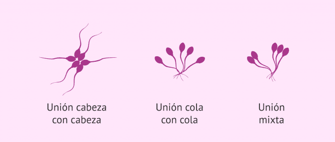 Imagen: Tipos de aglutinación de los espermatozoides