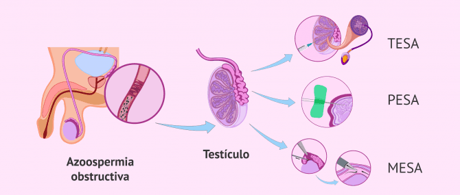 Imagen: ¿Cuáles son los métodos de aspiración de espermatozoides?