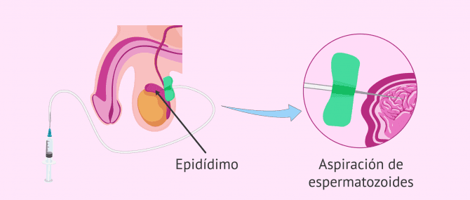 Imagen: Aspiración espermatozoides epidídimo por PESA