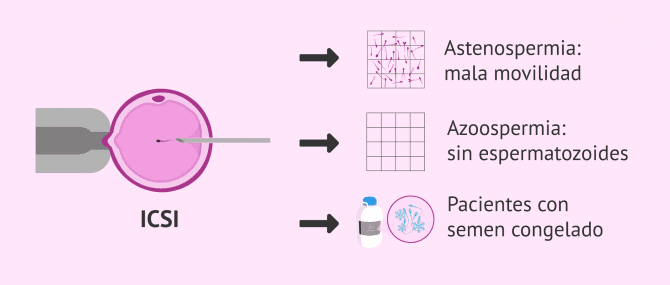 Imagen: ICSI como solución para la esterilidad masculina