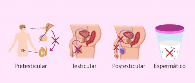 Imagen: Factores alterados en infertilidad masculina