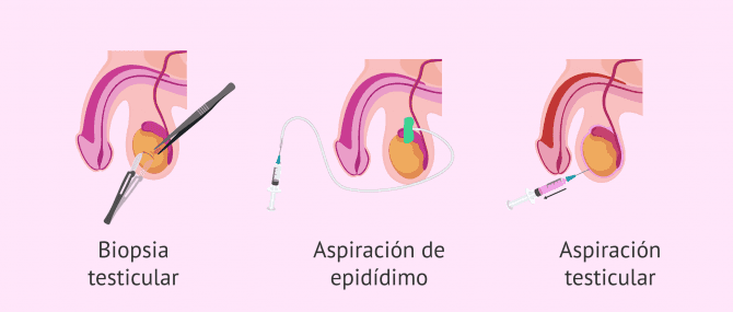 Imagen: Métodos para recuperar espermatozoides