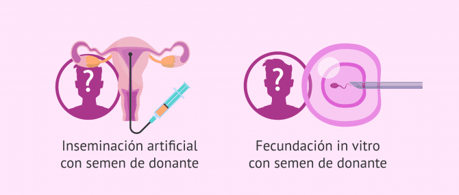 Imagen: Donación de semen como solución para la azoospermia