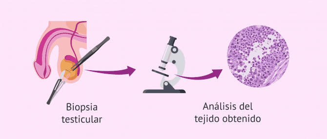 Imagen: Diagnóstico del síndrome de Sertoli