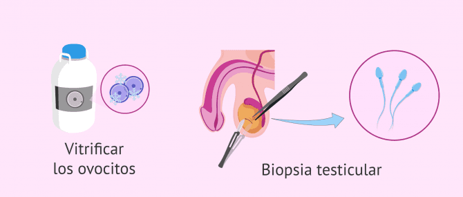 Imagen: Opciones para obtener espermatozoides