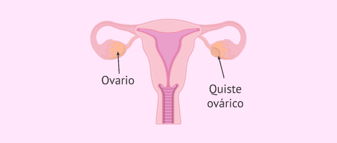 Imagen: Quistes ováricos foliculares y de cuerpo lúteo