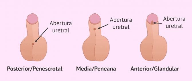 Imagen: ¿Cómo puede ser el hipospadia?