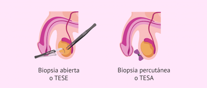 Imagen: Métodos para realizar la biopsia testicular