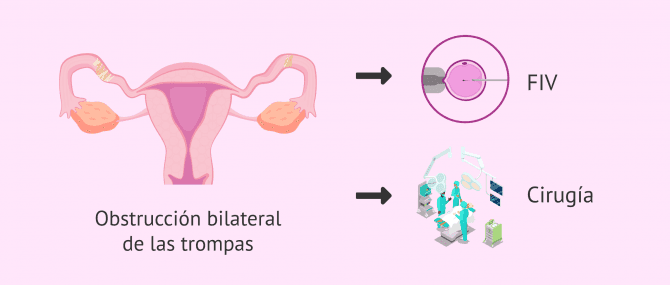 Imagen: Embarazo con obstrucción tubárica bilateral