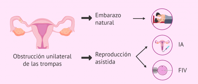 Imagen: Embarazo con obstrucción tubárica unilateral