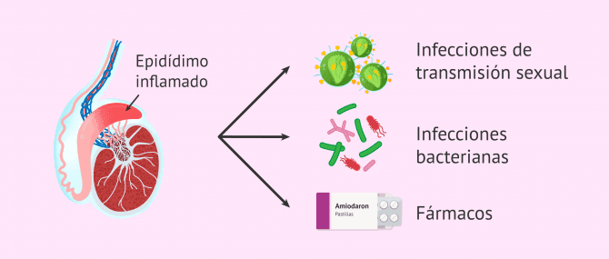 Imagen: La epididimitis y sus causas