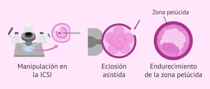 Imagen: ¿Qué influye en la probabilidad de gemelos en FIV?