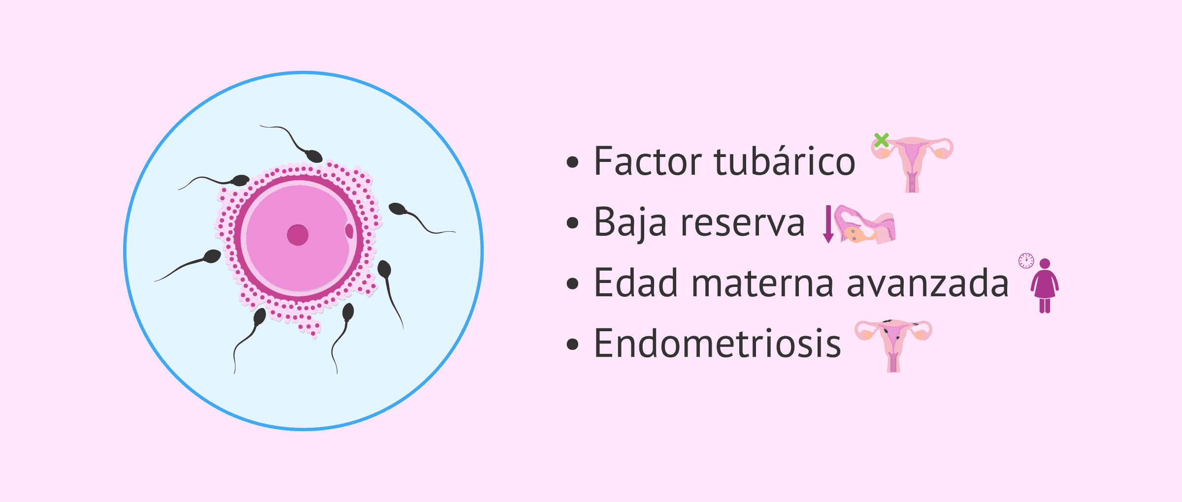 Imagen: Fecundación in vitro (FIV) e infertilidad femenina