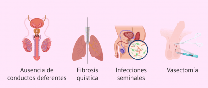 Imagen: ¿Cuándo se realiza la biopsia testicular?