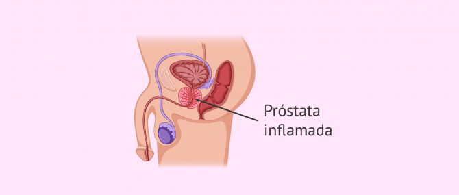 Imagen: Inflamación de la próstata o prostatitis