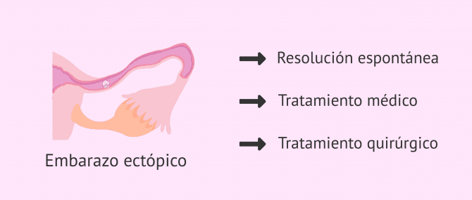 Imagen: Tratamiento del embarazo ectópico