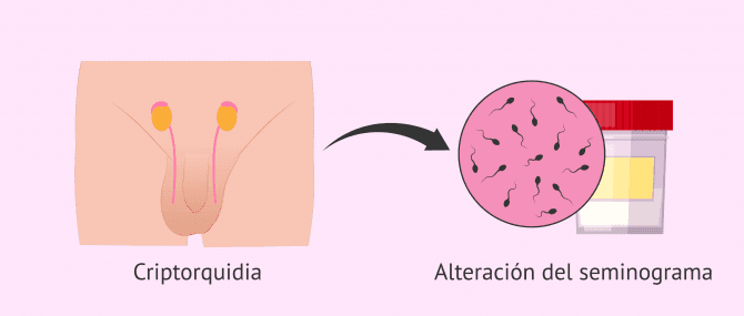 Imagen: ¿Influye la criptorquidia en la fertilidad masculina?