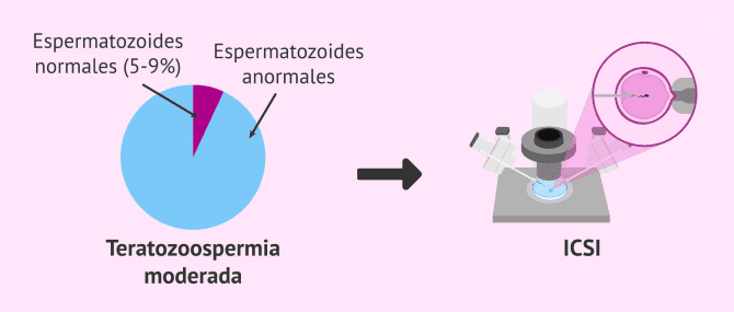 Imagen: Teratozoospermia moderada y embarazo