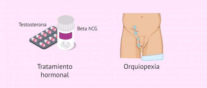 Imagen: Posibles tratamientos para la criptorquidia