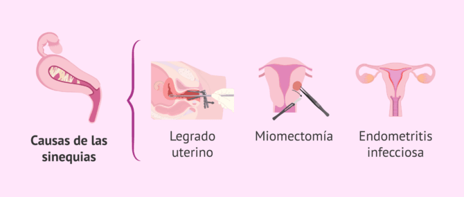 Imagen: ¿Por qué se aparecen las sinequias?