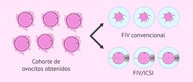 Imagen: Ciclo mixto FIV + ICSI