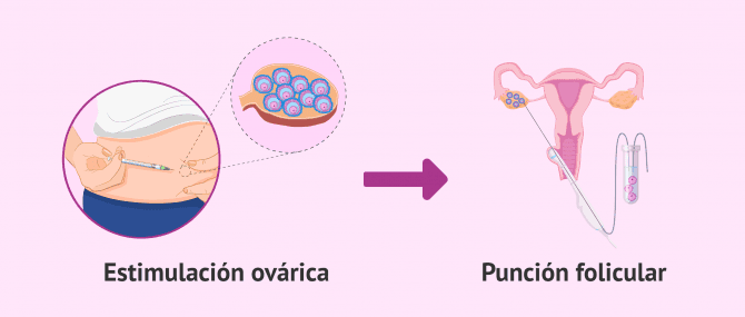 Imagen: Punción folicular tras estimulación ovárica