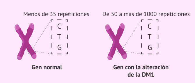 Imagen: Alteración genética de la distrofia miotónica de Steinert