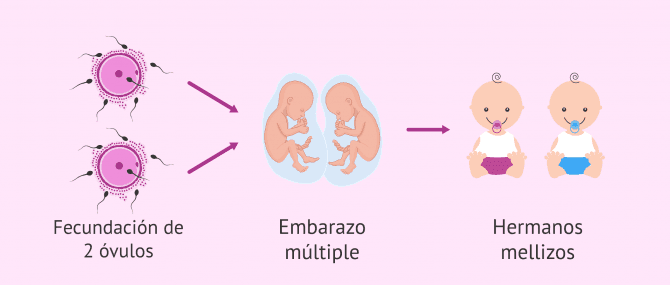 Imagen: Embarazo de mellizos por reproducción asistida