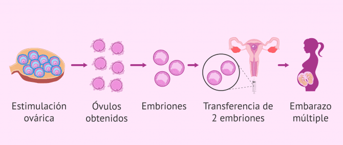 Imagen: Gemelos, mellizos y técnicas de reproducción asistida