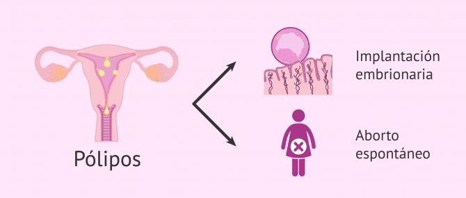 Imagen: Pólipos uterinos y fertilidad