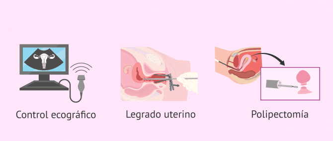 Imagen: Tratamiento para los pólipos endometriales