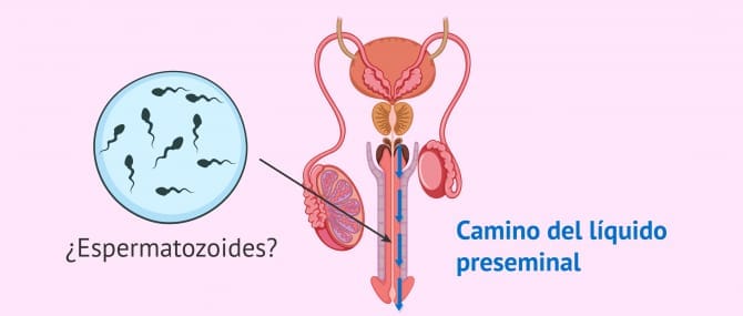 Imagen: Espermatozoides en el fluido preseminal