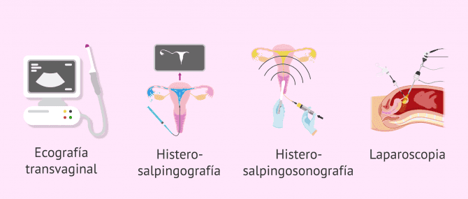 Imagen: ¿Cómo se diagnostica el factor tubárico?