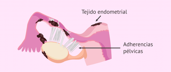 Imagen: Factor tubárico por endometriosis