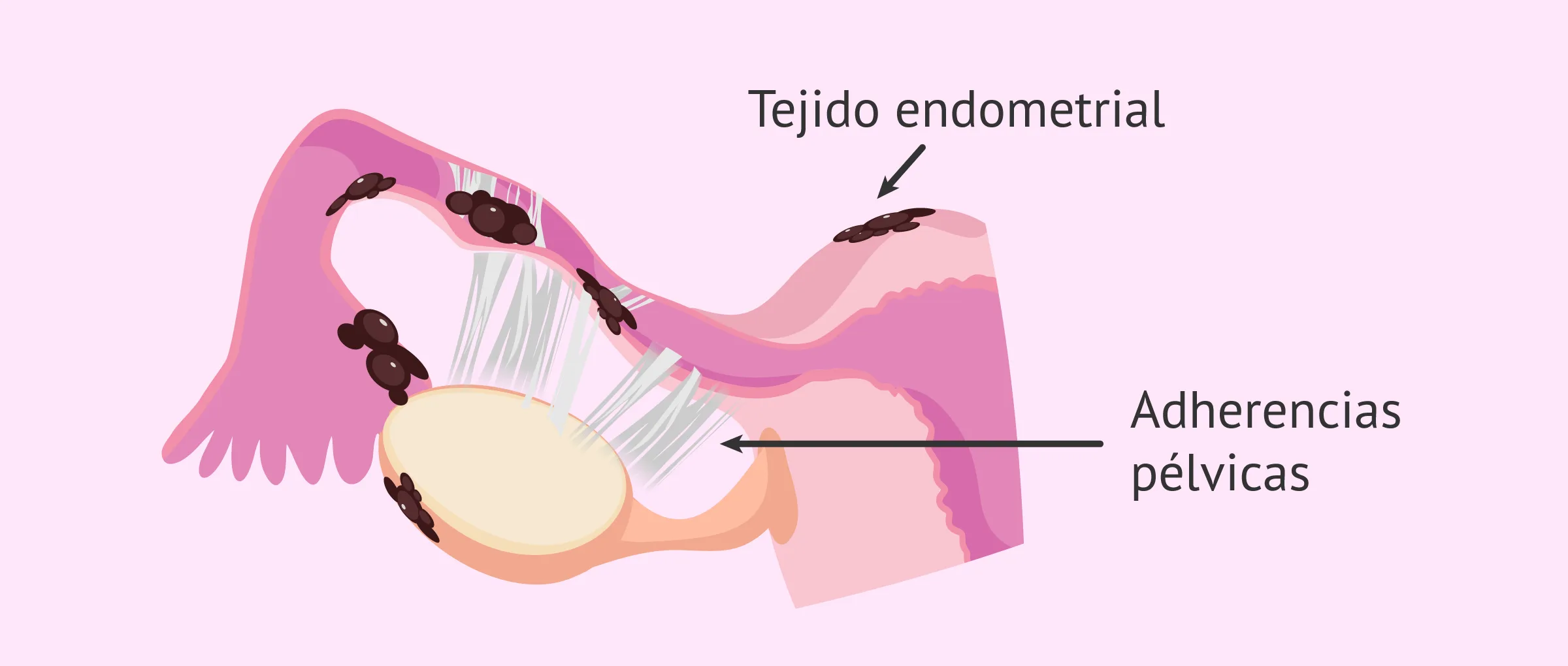 Factor tubárico por endometriosis