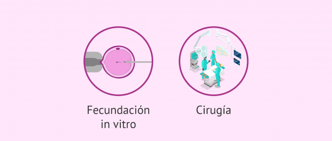 Imagen: Factor tubárico bilateral y posibilidad de embarazo