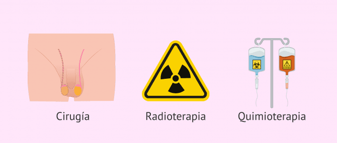 Imagen: Opciones terapéuticas para el cáncer de testículo